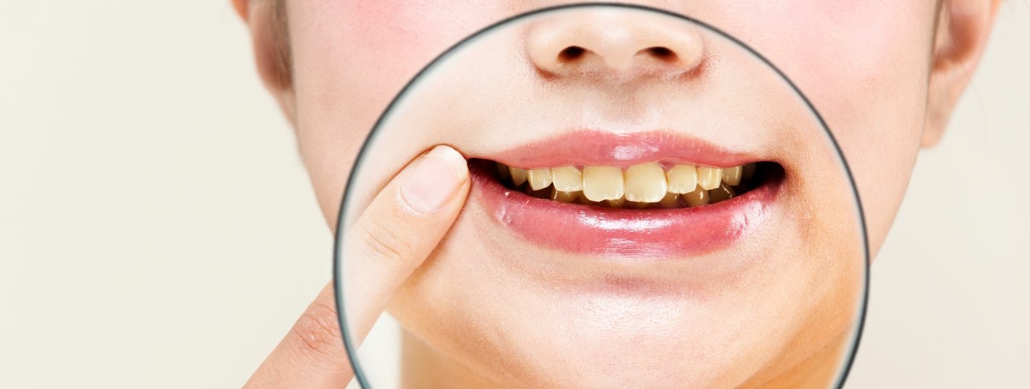 歯の黄ばみが気になる方